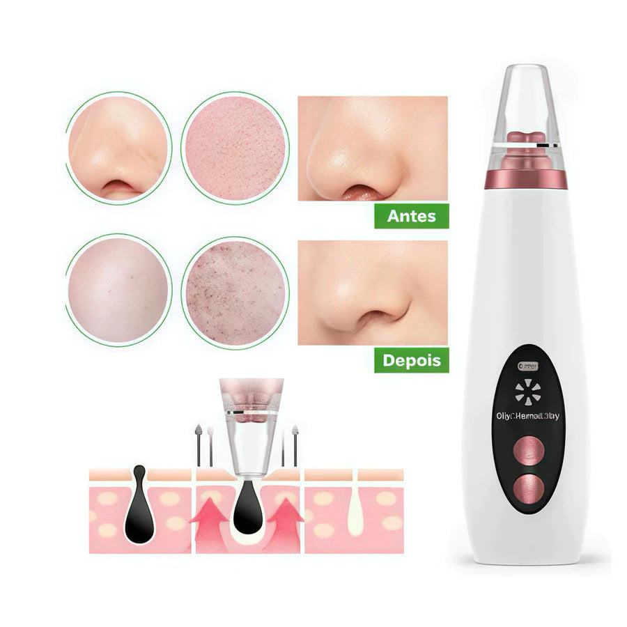 Removedor de Cravos por Sucção – Limpeza Profunda dos Poros