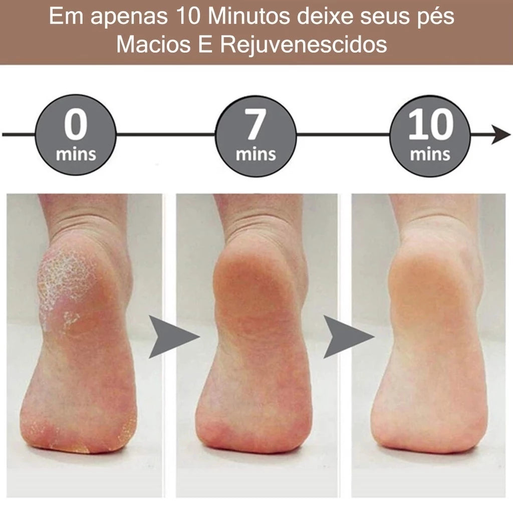 Lixador Elétrico para Pés – Remove Calos e Rachaduras Instantaneamente